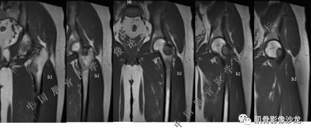 【病例】股骨近端占位性病变4例影像讨论