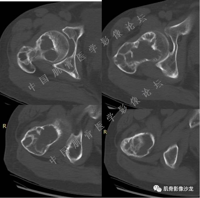 【病例】股骨近端占位性病变4例影像讨论
