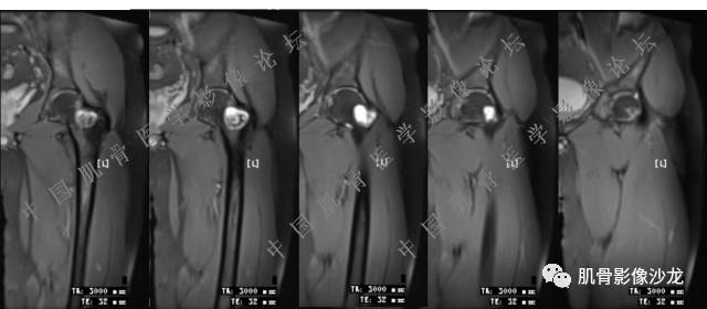 【病例】股骨近端占位性病变4例影像讨论
