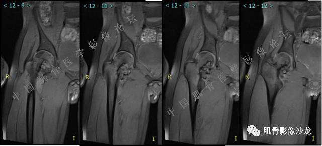 【病例】股骨近端占位性病变4例影像讨论