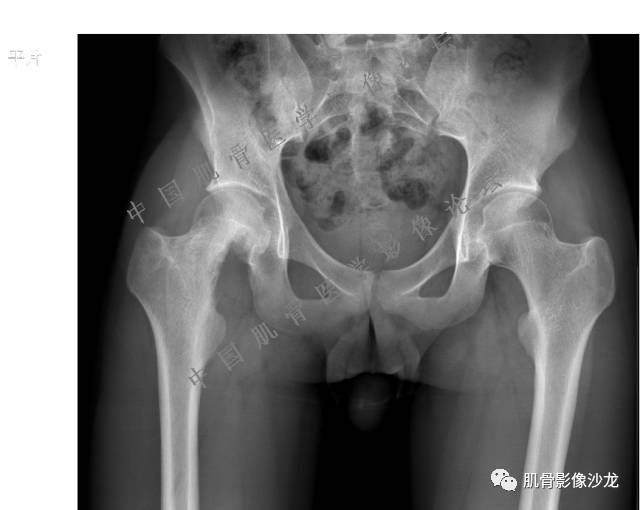 【病例】股骨近端占位性病变4例影像讨论