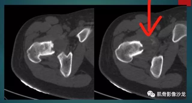 【病例】股骨近端占位性病变4例影像讨论