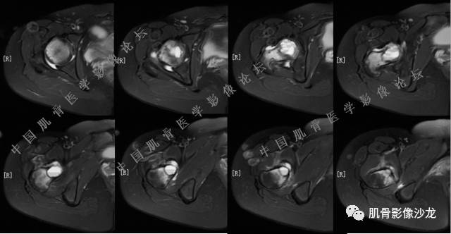 【病例】股骨近端占位性病变4例影像讨论