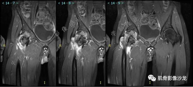 【病例】股骨近端占位性病变4例影像讨论