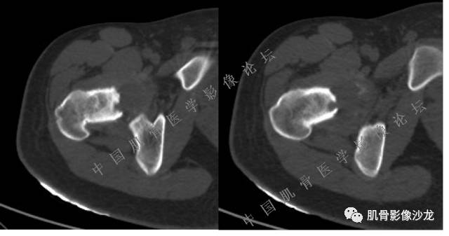【病例】股骨近端占位性病变4例影像讨论
