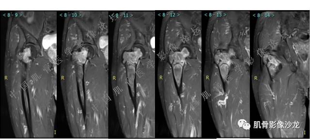 【病例】股骨近端占位性病变4例影像讨论