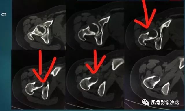 【病例】股骨近端占位性病变4例影像讨论