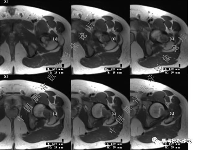 【病例】股骨近端占位性病变4例影像讨论