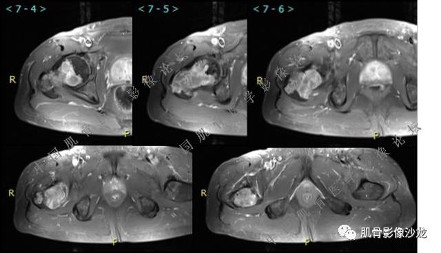【病例】股骨近端占位性病变4例影像讨论