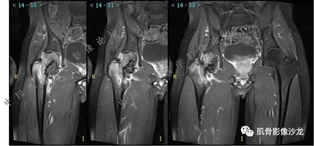 【病例】股骨近端占位性病变4例影像讨论