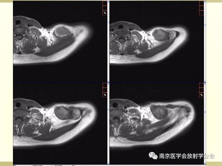 【病例】肱骨嗜酸性肉芽肿1例X线CT及MR影像表现