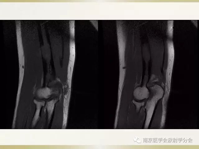 【病例】肱骨嗜酸性肉芽肿1例X线CT及MR影像表现