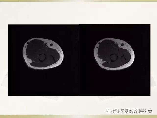 【病例】肱骨嗜酸性肉芽肿1例X线CT及MR影像表现
