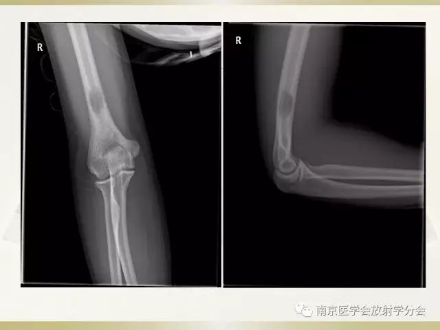 【病例】肱骨嗜酸性肉芽肿1例X线CT及MR影像表现