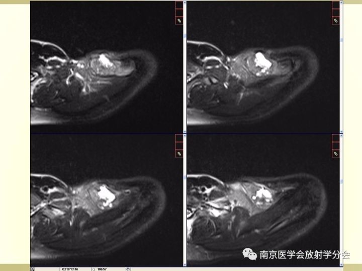 【病例】肱骨嗜酸性肉芽肿1例X线CT及MR影像表现