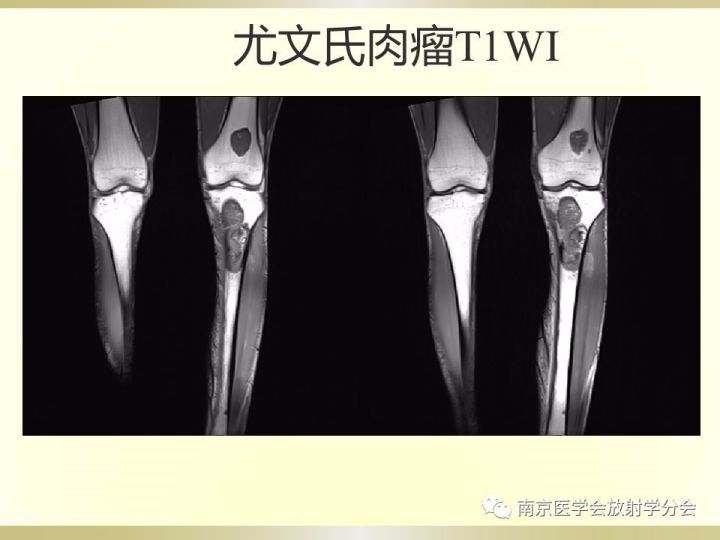 【病例】肱骨嗜酸性肉芽肿1例X线CT及MR影像表现