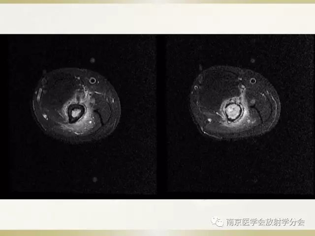【病例】肱骨嗜酸性肉芽肿1例X线CT及MR影像表现