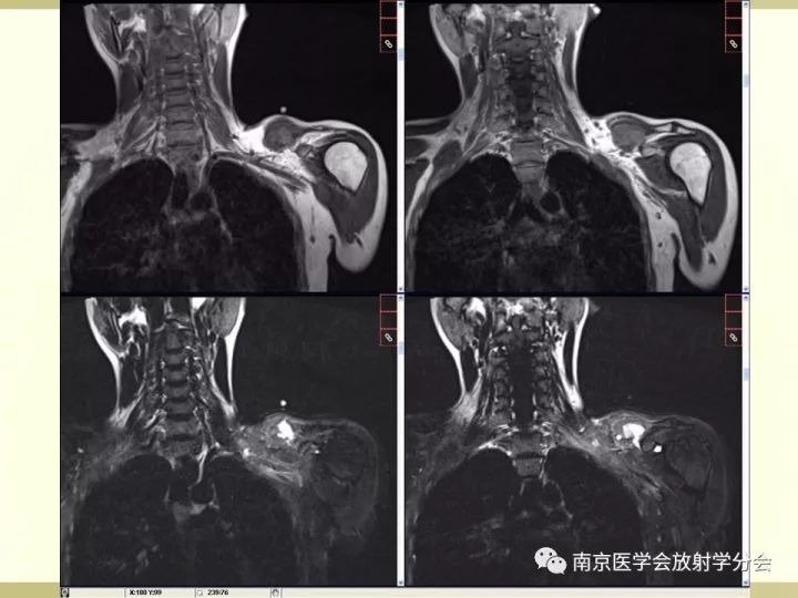 【病例】肱骨嗜酸性肉芽肿1例X线CT及MR影像表现