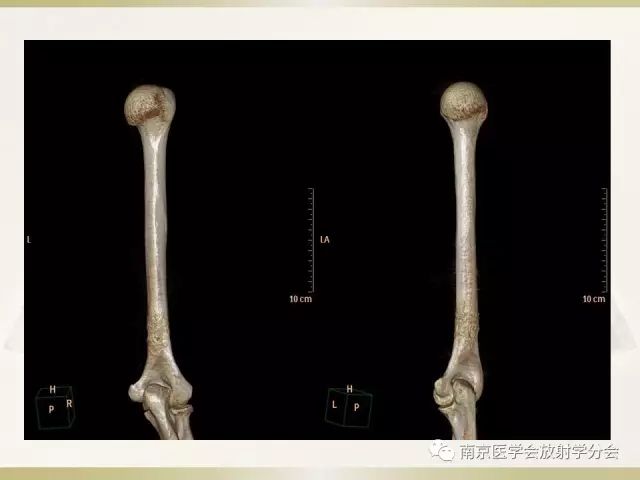 【病例】肱骨嗜酸性肉芽肿1例X线CT及MR影像表现