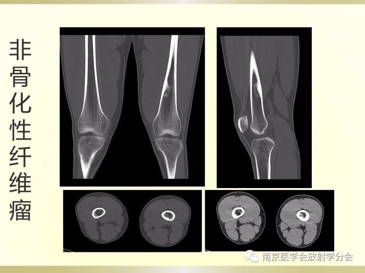 【病例】肱骨嗜酸性肉芽肿1例X线CT及MR影像表现