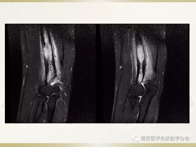 【病例】肱骨嗜酸性肉芽肿1例X线CT及MR影像表现