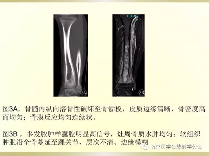 【病例】肱骨嗜酸性肉芽肿1例X线CT及MR影像表现