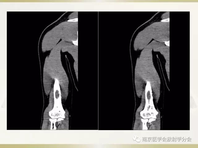 【病例】肱骨嗜酸性肉芽肿1例X线CT及MR影像表现