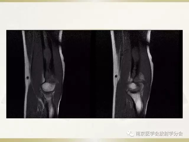 【病例】肱骨嗜酸性肉芽肿1例X线CT及MR影像表现