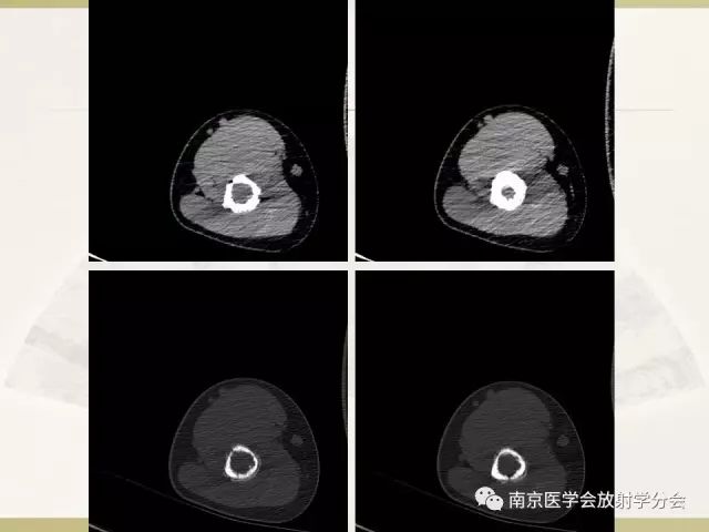 【病例】肱骨嗜酸性肉芽肿1例X线CT及MR影像表现