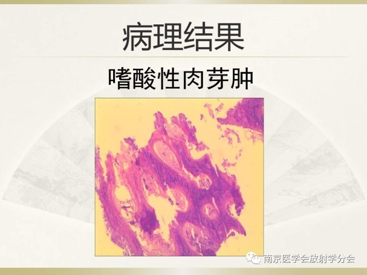 【病例】肱骨嗜酸性肉芽肿1例X线CT及MR影像表现