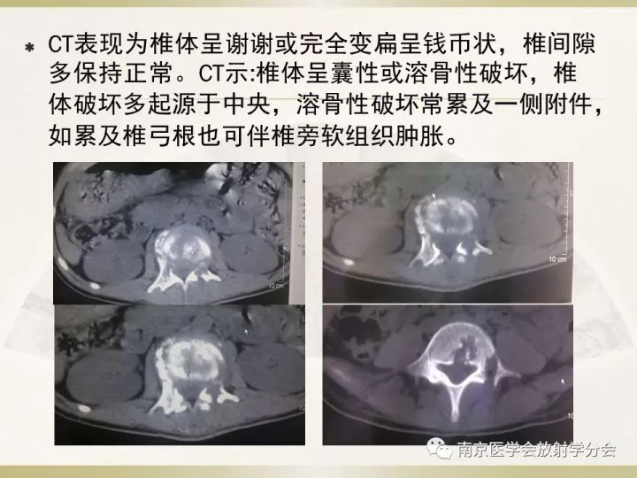 【病例】肱骨嗜酸性肉芽肿1例X线CT及MR影像表现