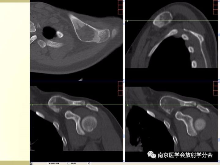 【病例】肱骨嗜酸性肉芽肿1例X线CT及MR影像表现