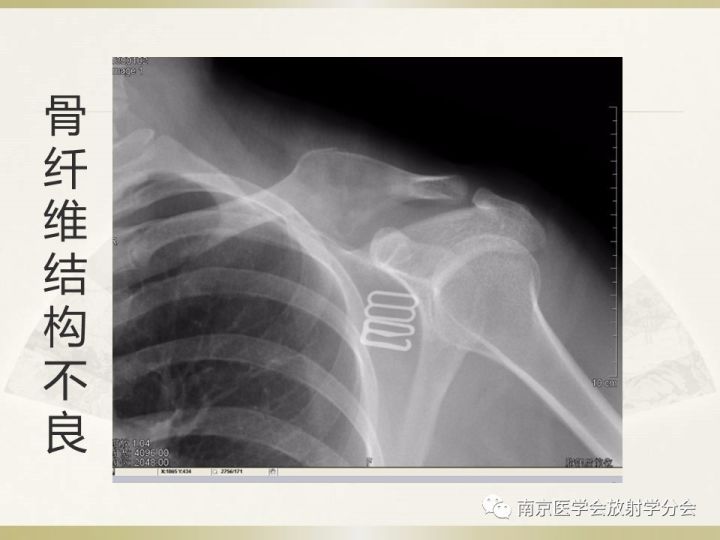 【病例】肱骨嗜酸性肉芽肿1例X线CT及MR影像表现