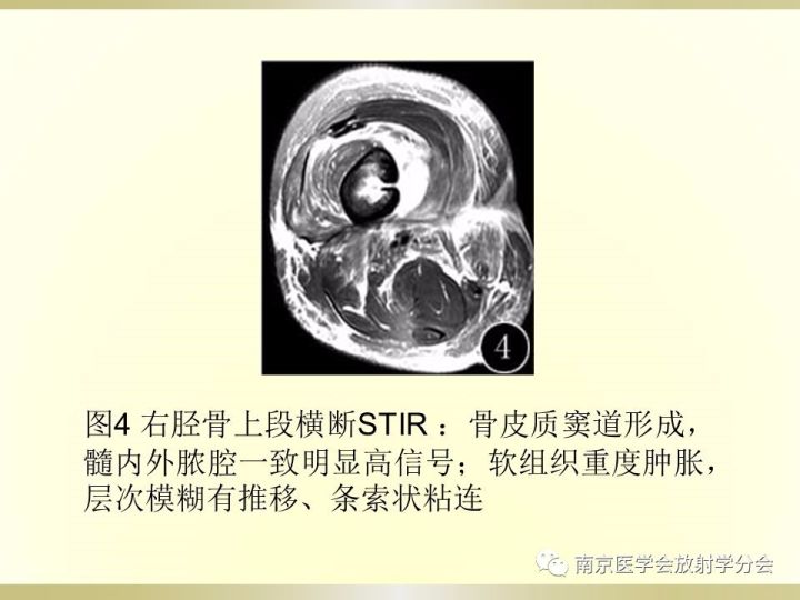 【病例】肱骨嗜酸性肉芽肿1例X线CT及MR影像表现