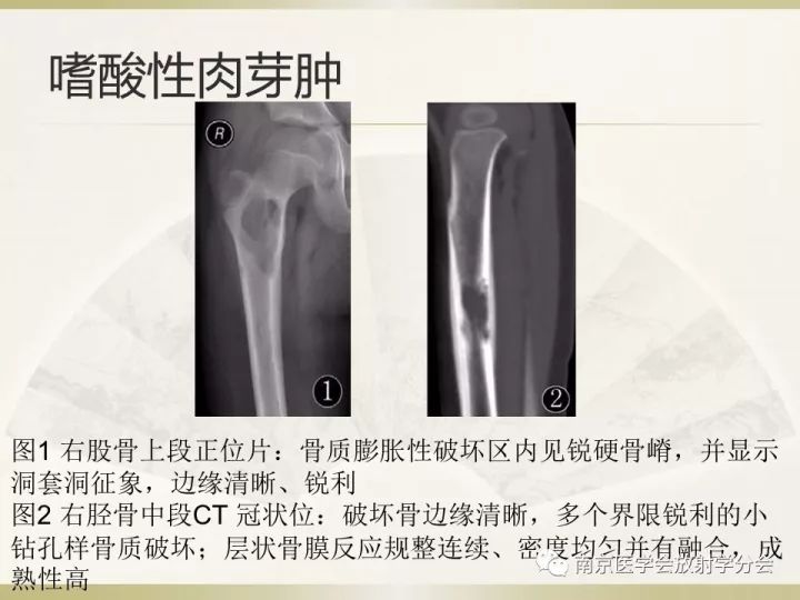 【病例】肱骨嗜酸性肉芽肿1例X线CT及MR影像表现
