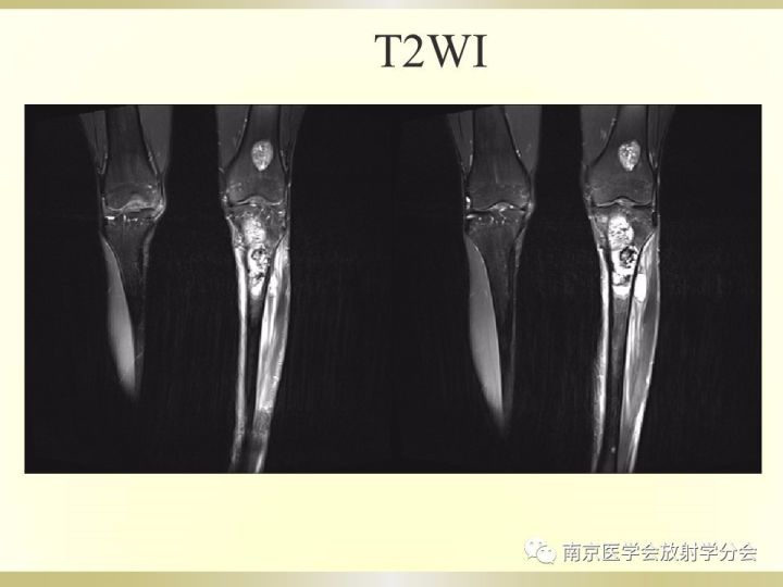 【病例】肱骨嗜酸性肉芽肿1例X线CT及MR影像表现