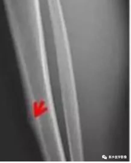 【病例】左股骨大转子骨样骨瘤1例X线CT