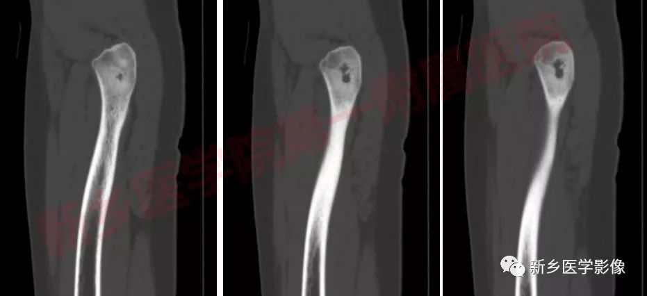 【病例】左股骨大转子骨样骨瘤1例X线CT
