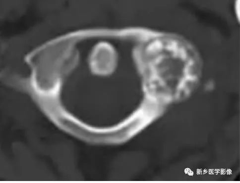 【病例】左股骨大转子骨样骨瘤1例X线CT