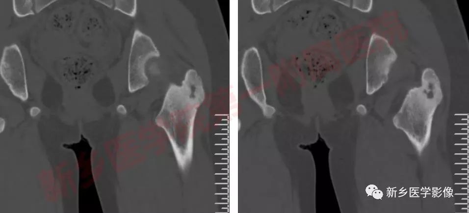 【病例】左股骨大转子骨样骨瘤1例X线CT