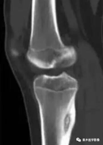 【病例】左股骨大转子骨样骨瘤1例X线CT