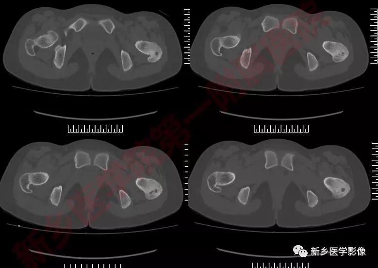 【病例】左股骨大转子骨样骨瘤1例X线CT