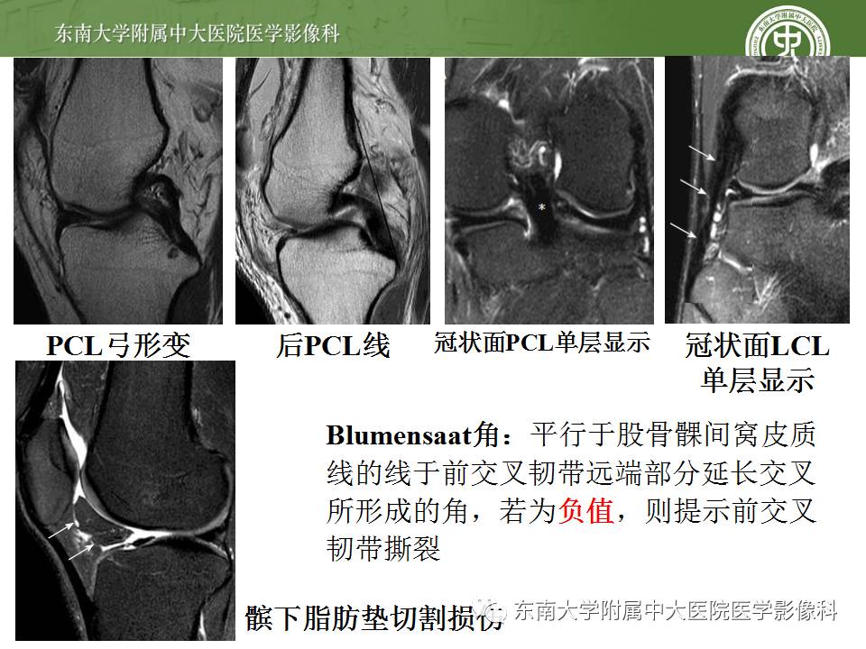【病例】前交叉韧带损伤1例MR影像诊断