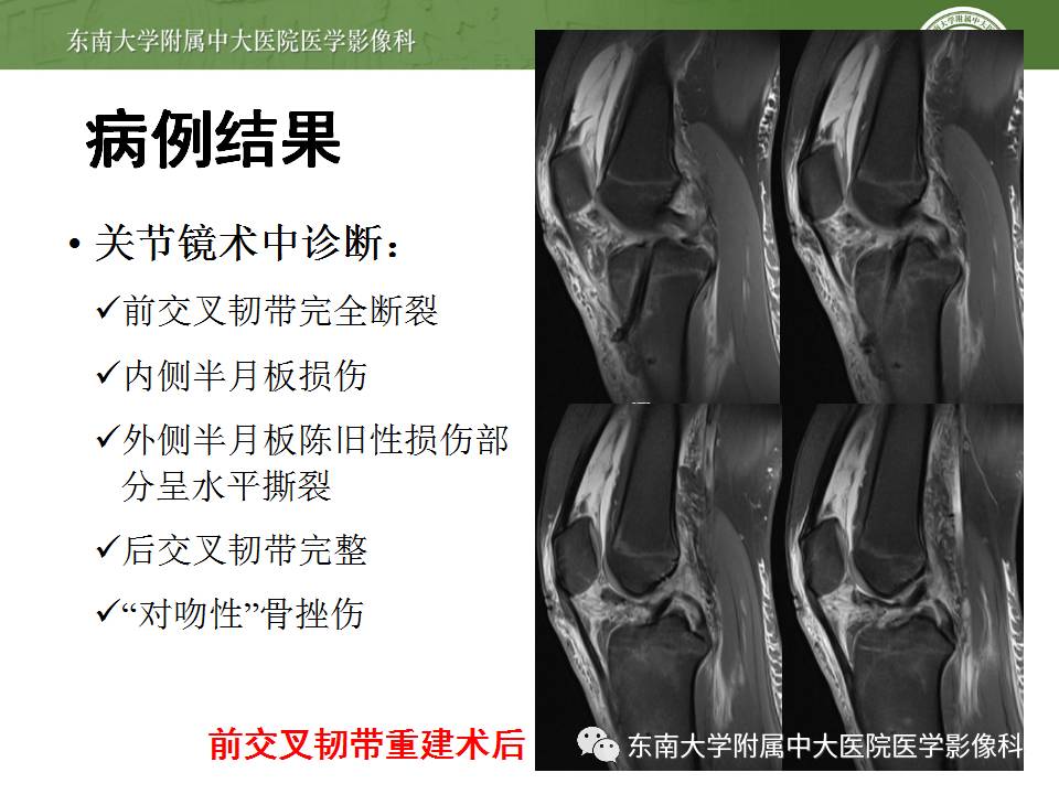【病例】前交叉韧带损伤1例MR影像诊断