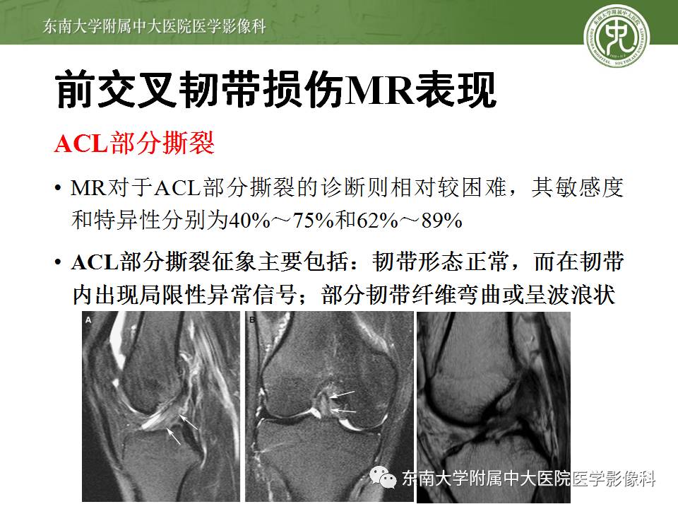 【病例】前交叉韧带损伤1例MR影像诊断
