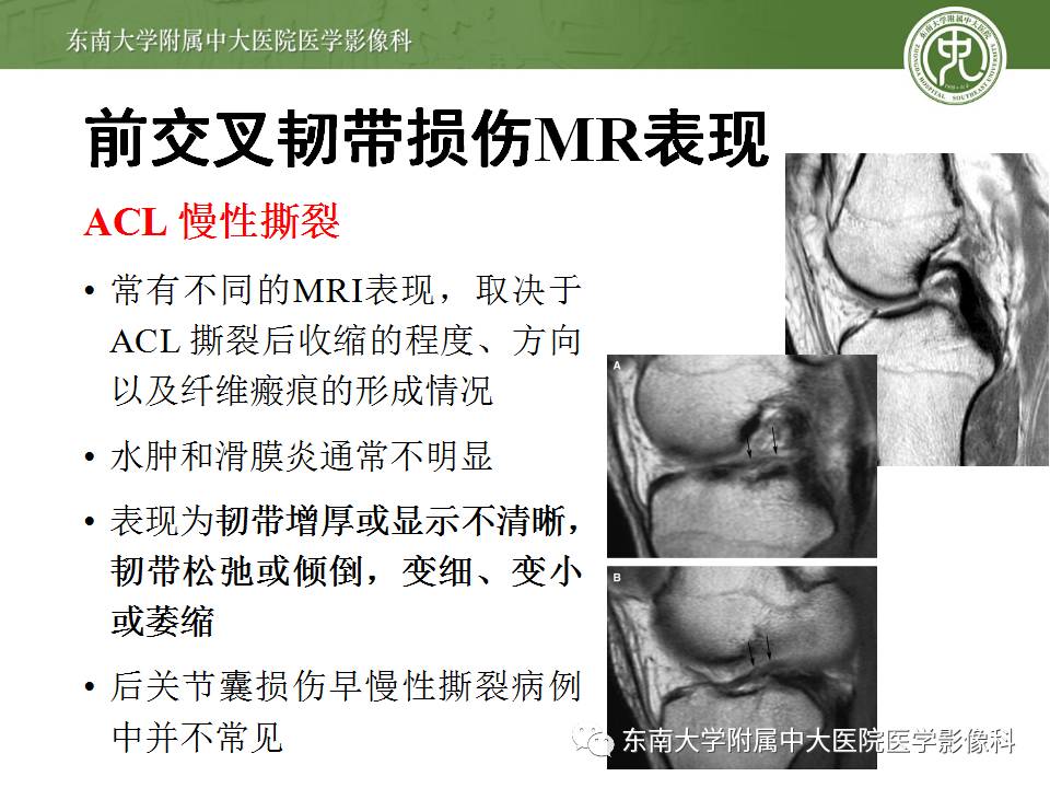 【病例】前交叉韧带损伤1例MR影像诊断