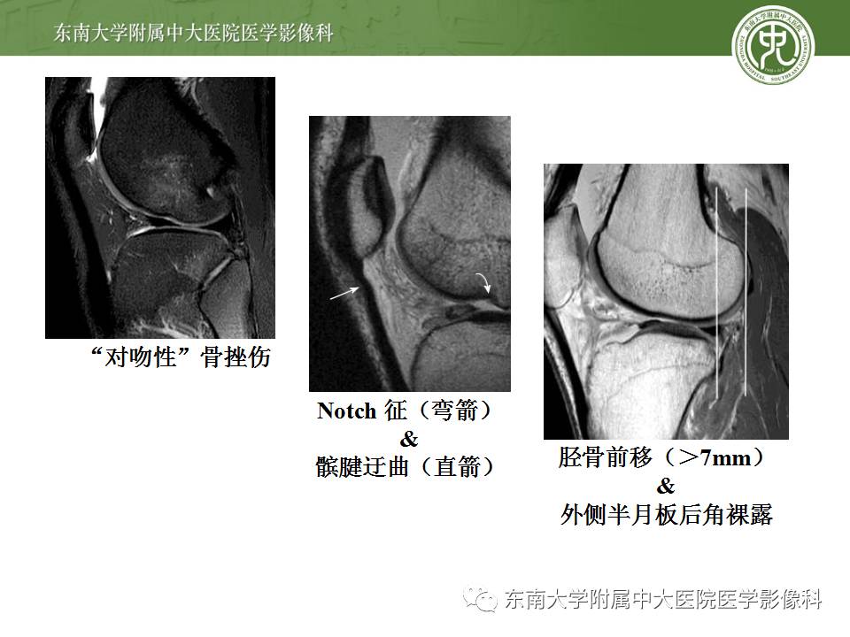 【病例】前交叉韧带损伤1例MR影像诊断