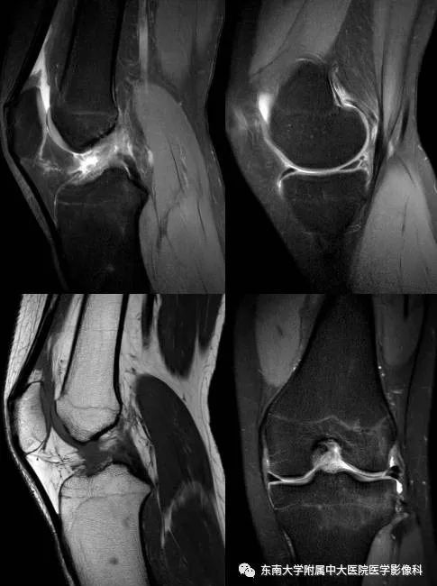 【病例】前交叉韧带损伤1例MR影像诊断