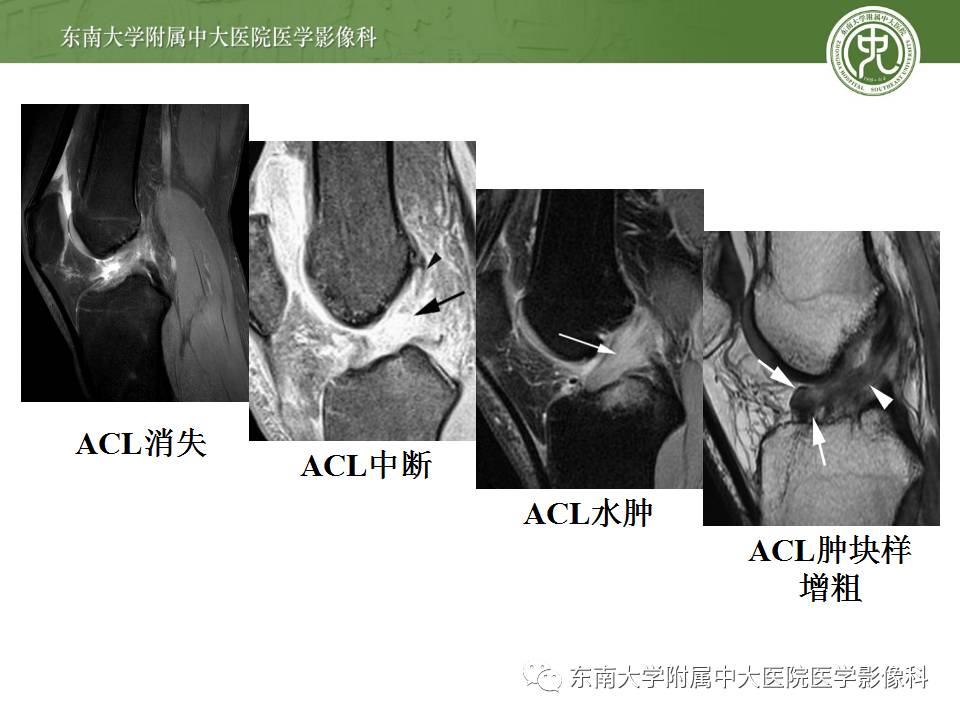 【病例】前交叉韧带损伤1例MR影像诊断