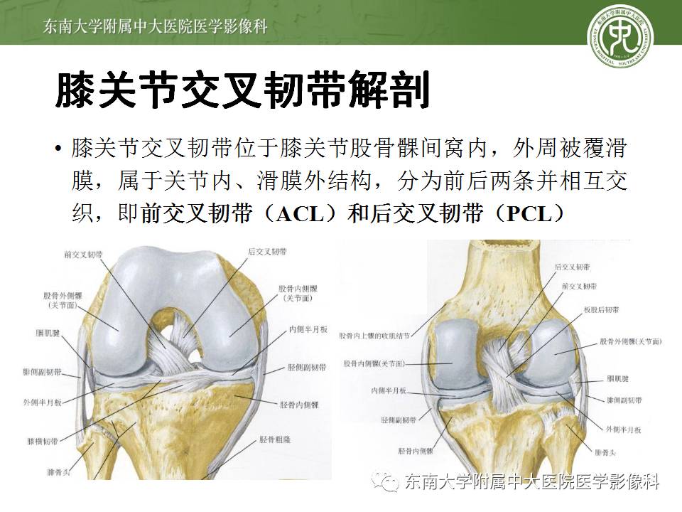 【病例】前交叉韧带损伤1例MR影像诊断